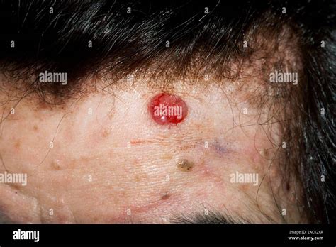 Close Up Of Skin Cancer Basal Cell Carcinoma On The Forehead In A 75