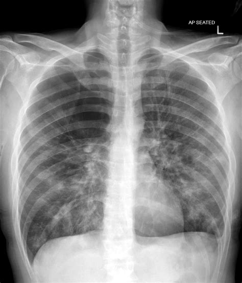 Emphysema Chest X Ray