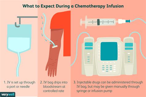 Chemotherapy Infusion For Breast Cancer Procedure And Side Effects