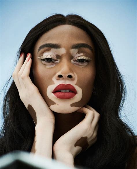 Love The Skin Your In Winnie Harlow Vitiligo Model Vitiligo