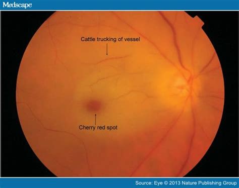 Sialidosis (type i = cherry. A Review of Central Retinal Artery Occlusion