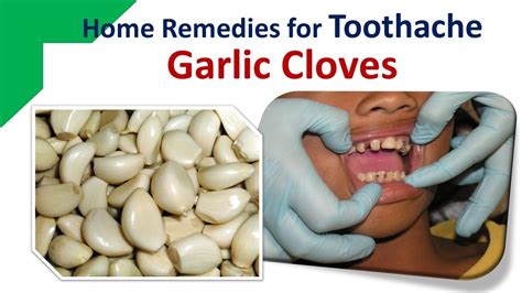 Home Remedies For Toothache Garlic Cloves Youtube