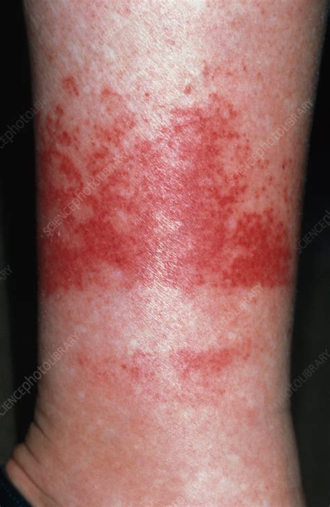 Purpura Rash On Womans Leg Above Sock Line Stock Image M2400221