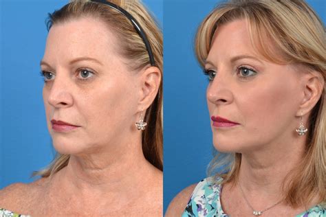 Facelift Photos Melbourne Fl Patient 12130