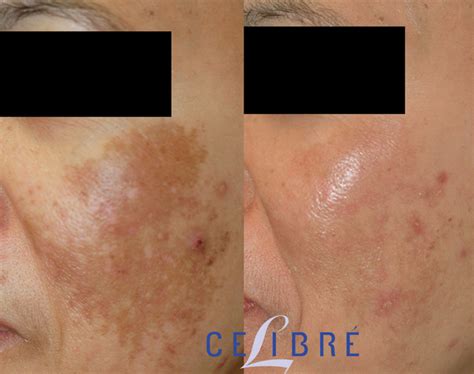 Melasma Before And After Pictures