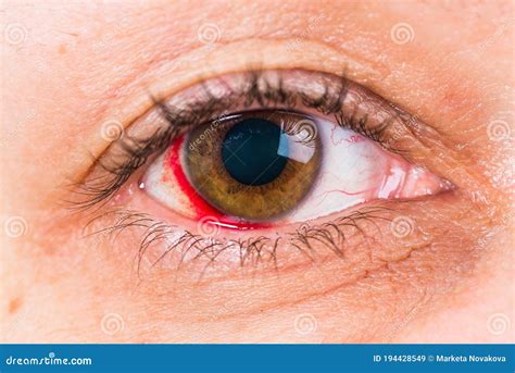 Detail Of Woman Brown Eye With The Damage And Blood In Eye Stock Image Image Of Blood Brown