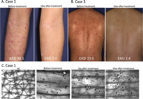 Restoration Of Sweating Disturbance In Atopic Dermatitis Treated With