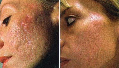 Healing Scars With The Scar Solution Review 50 Off Here Best Acne