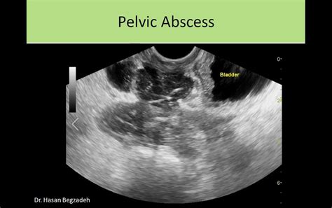 Pelvic Abscess Ultrasound Sonography Ultrasound School Ultrasound