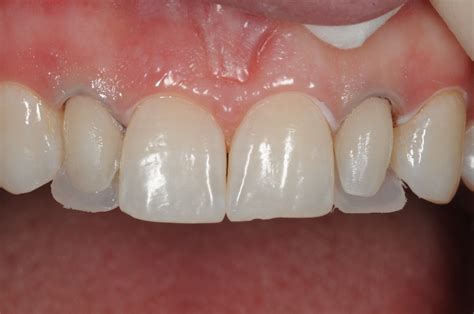 Services Peg Laterals Brisbane Prosthodontics