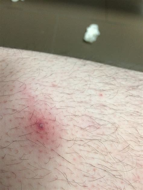 This is why the bumps it is also meant to be a spot treatment. Very angry ingrown hair on my leg. The joys of being a ...
