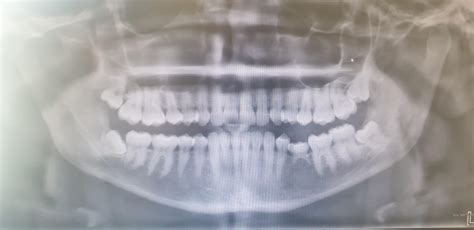 The X Ray Of My Jaw To Correct My Temporomandibular Joint Disorder And