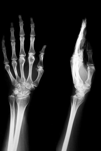 Normal Wrist X Ray Stock Photos Pictures And Royalty Free Images Istock