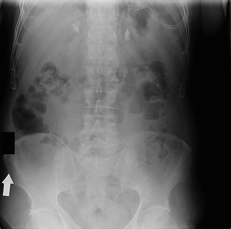 Adrenal Calcifications Bilateral Radiology Case