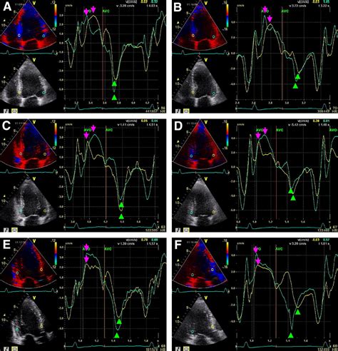 Impact Of Cardiac Contractility Modulation On Left Ventricular Global