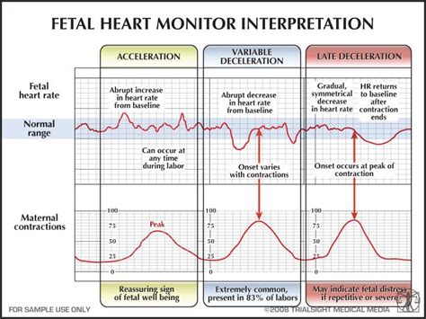 Fetal Heart Monitor Interpretation Nursing School Tips Pediatric Nursing Ob Nursing