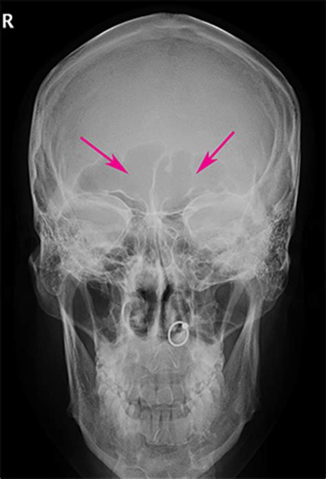 Forehead and Eyebrow ridge bone Contouring Surgery (Male Brow bossing