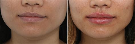 Lip Enhancement Photos Houston Tx Patient 9427