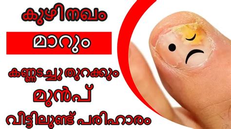 Today's latest malayalam news from kerala, india, gulf & world. കുഴി നഖത്തിന് വീട്ടിലുണ്ട് പരിഹാരം | Health Tips Malayalam ...