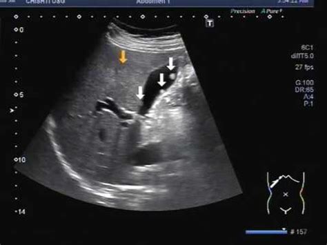 Maybe you would like to learn more about one of these? Ultrasound Video showing multiple polyps in the gall ...