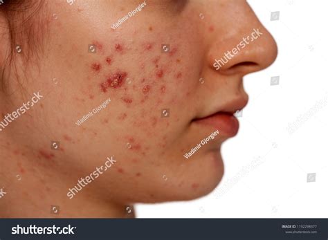 Profile Closeup Teenage Girl Problematic Skin Stock Photo 1192298377