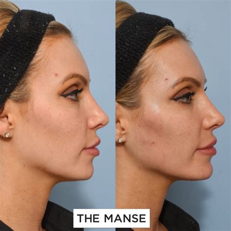 Jawline Dermal Filler Best Clinic Sydney For Dermal Fillers