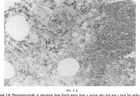 Figure 5 From Granular Histiocytosis Of Pelvic Lymph Nodes Following