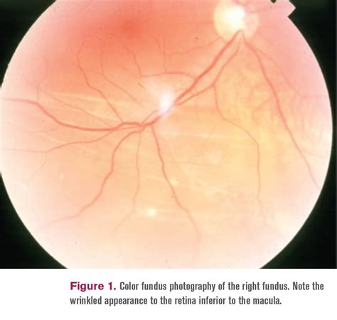 When A Retinal Detachment Isnt A Retinal Detachment Optometry Times