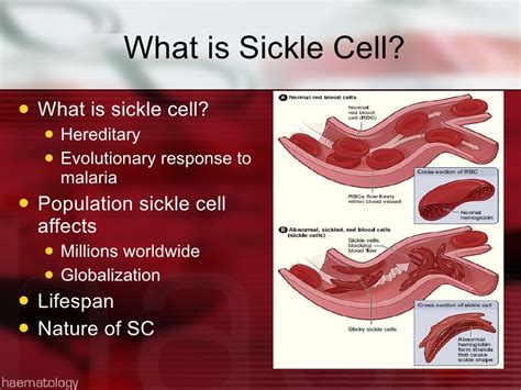 Overcoming Stigma In Sickle Cell Disease