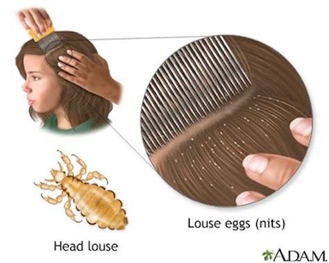 Several Cases Of Head Lice Reported On Campus The Beacon