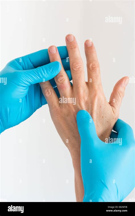 Contact Dermatitis On Finger Stock Photo Alamy