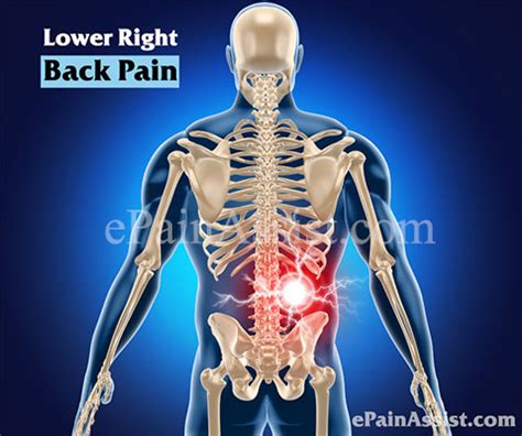 Lower Right Back Pain Causes Symptoms Treatment