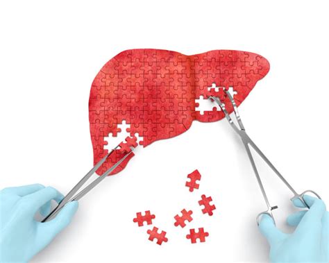 New Aga Guidance Addresses Cancer Screening In Patients With Nafld