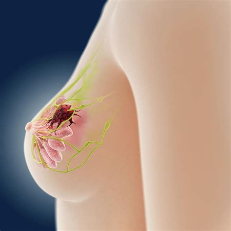 Breast Cancer Photograph By Springer Medizin Science Photo Library Fine Art America