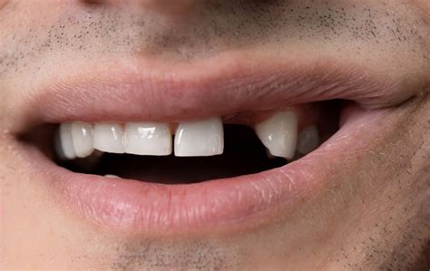 Buy a dental plan today & start saving money at the dentist. Emergency Dentist Lansing, MI | (517) 333-3160 | Healthy ...
