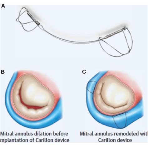 Indirect Mitral Annuloplasty Using The Carillon Device A The