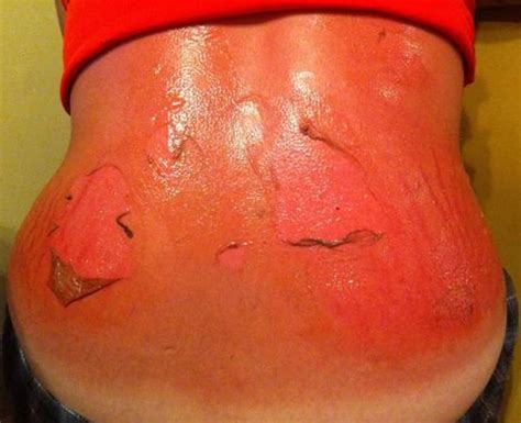 This Sunburn Horror Story Shows Expired Sunscreen Doesnt Protect Your