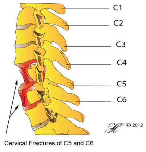 Cervical Fracture Orthoanswer