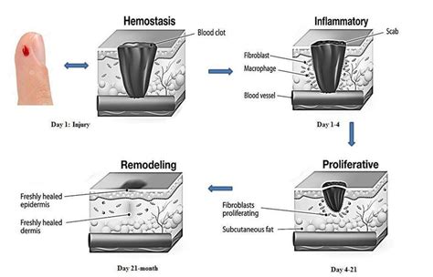 Wound Healing Phases Schematic Diagram Elucidating The Four Distinct