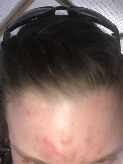 Routine Help Cluster Of Eight Blind Pimples On Forehead