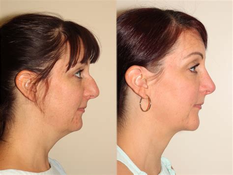 Chin And Cheek Implant Surgery In Vancouver Dr Denton