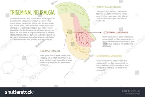 Infographic Trigeminal Neuralgia Disease Areas Affected Stock Vector