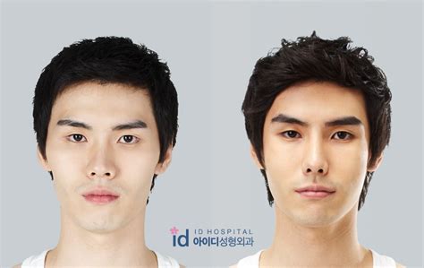 Id Hospital Korea Plastic Surgery Men Plastic Surgery Before And After