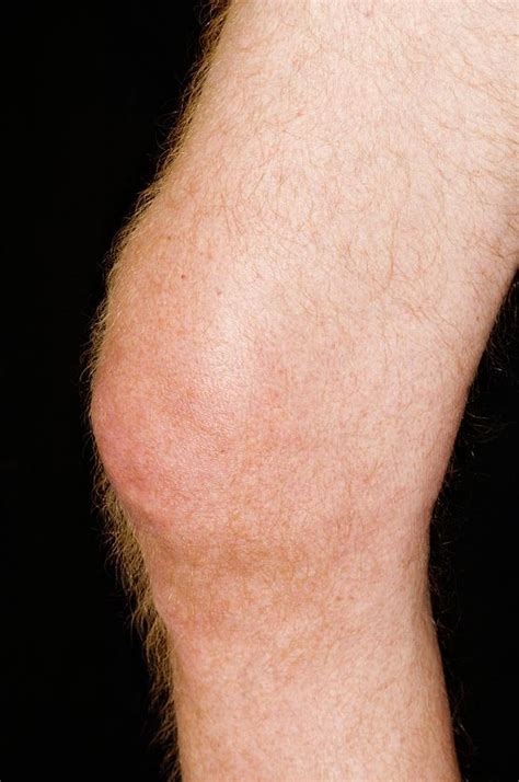 Gout In The Knee Photograph By Dr P Marazziscience Photo Library