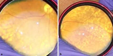 Dilated Fundus Examination Showed Diffuse Extramacular Drusen Of The