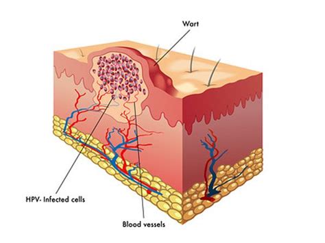 Ada yang di kaki, ada yang di tangan. Cara Hilangkan Ketuat (Dengan Gambar) | Warts, Warts ...
