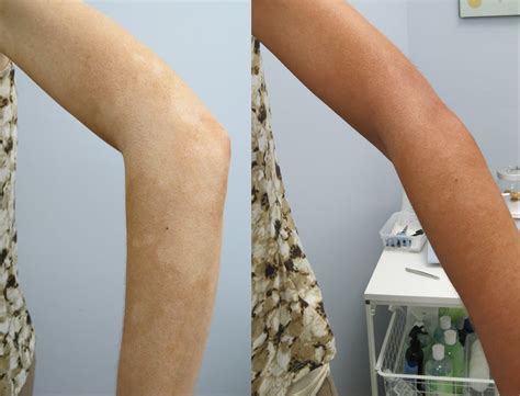 Vitiligo Camouflage Before And After Yelp
