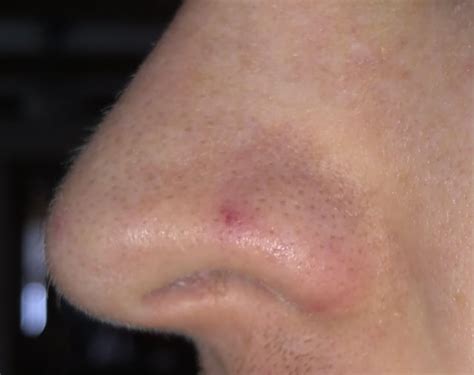 Skin Concerns Red Blemishpore On Nose That Will Not Go Away R