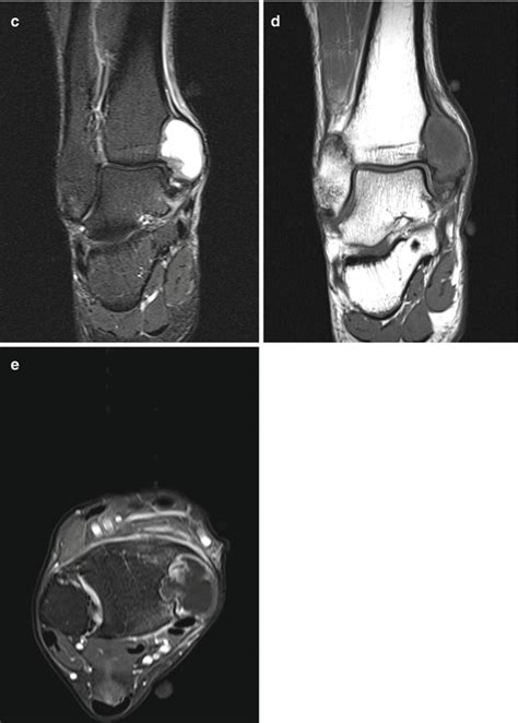 Dual Energy Ct In Musculoskeletal Tumors Oncohema Key