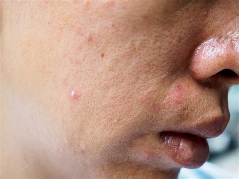 Premium Photo Pimple And Acne On Face Skin Zoom Macro
